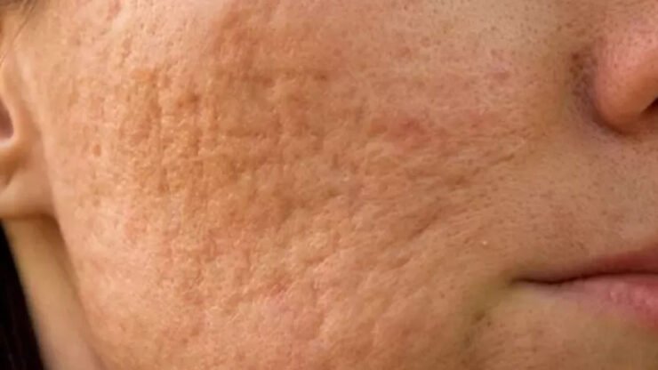 IS IT POSSIBLE TO GET RID OF ACNE SCARS?