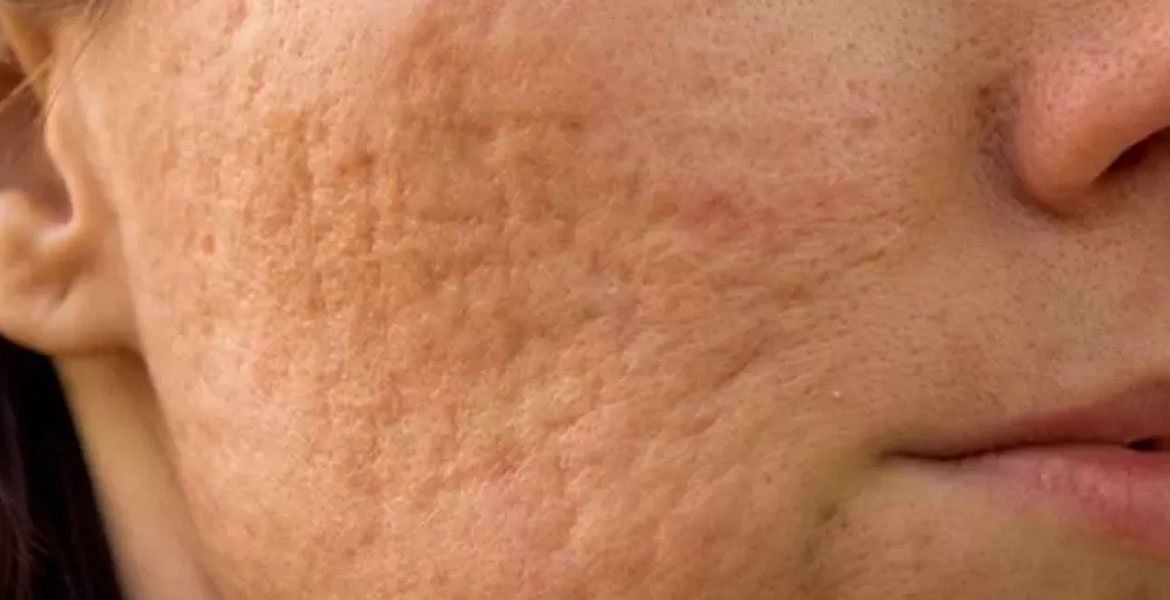 IS IT POSSIBLE TO GET RID OF ACNE SCARS?