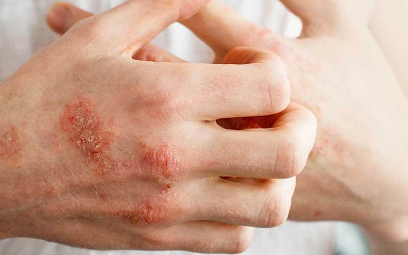 Eczema