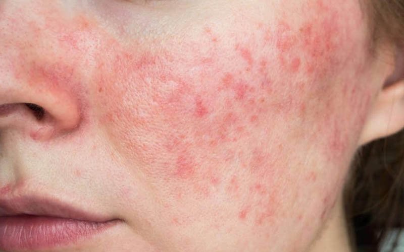 Rosacea