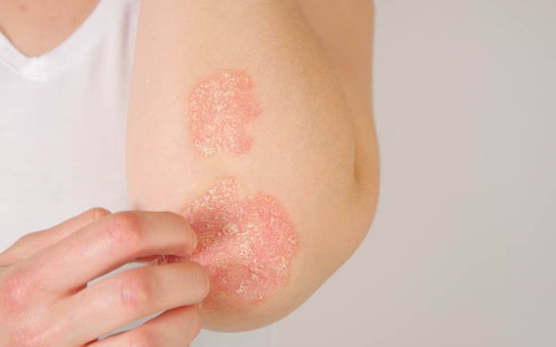 Psoriasis